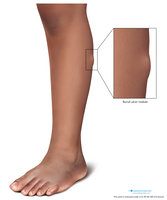 Medical Illustration of a Buruli ulcer nodule