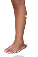 Medical Illustration of Buruli ulcer with an early stage lesion