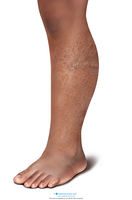 Medical Illustration of Buruli ulcer with plaque and oedema