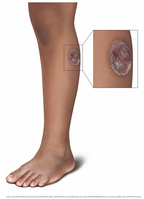 Medical illustrations of a Mother Yaw and Buruli ulcer on the leg - SET 1